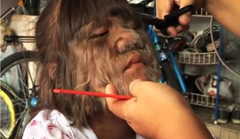 Meet the hairiest girl of the world and her transformation.